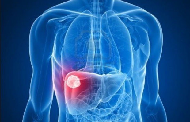 โรคใกล้ตัวคนไทย!! “มะเร็งตับ” สาเหตุ+แนวทางรักษา