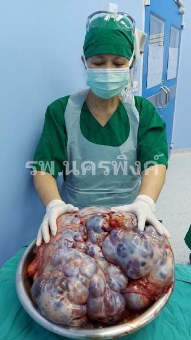 ช็อค! หมอไทยเปิดประสบการณ์ ผ่าตัดมะเร็งรังไข่ขนาดยักษ์