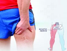 Sciatica pain อาการปวดร้าวลงขา
