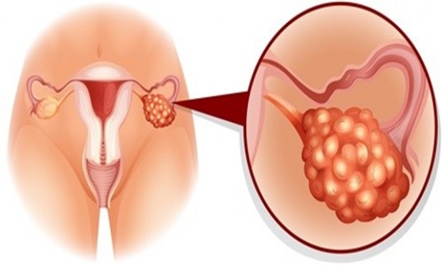 7ความเสี่ยง\"มะเร็งรังไข่\"โรคร้ายที่พบมากในหญิงไทย