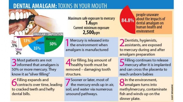 อะมัลกัมที่ใช้อุดฟันอาจเป็นอันตรายต่อสุขภาพ