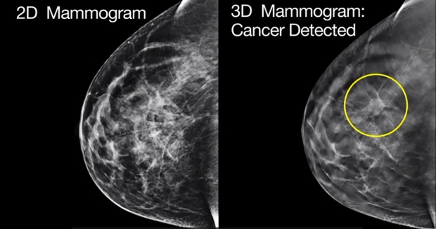 สถาบันมะเร็งแห่งชาติ ผุดโปรเจกต์ใหม่ “คัดกรองมะเร็งเต้านมจากเลือด”
