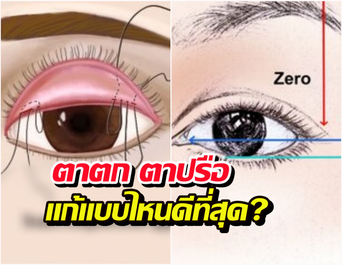 แก้ปัญหาตาตก ตาปรือ วิธีไหนดี ระหว่าง Subbrown Lift หรือ ทำตา2ชั้น