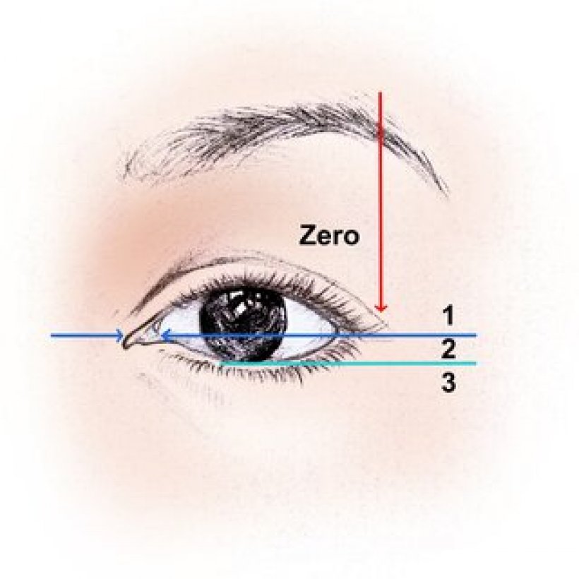 แก้ปัญหาตาตก ตาปรือ วิธีไหนดี ระหว่าง Subbrown Lift หรือ ทำตา2ชั้น