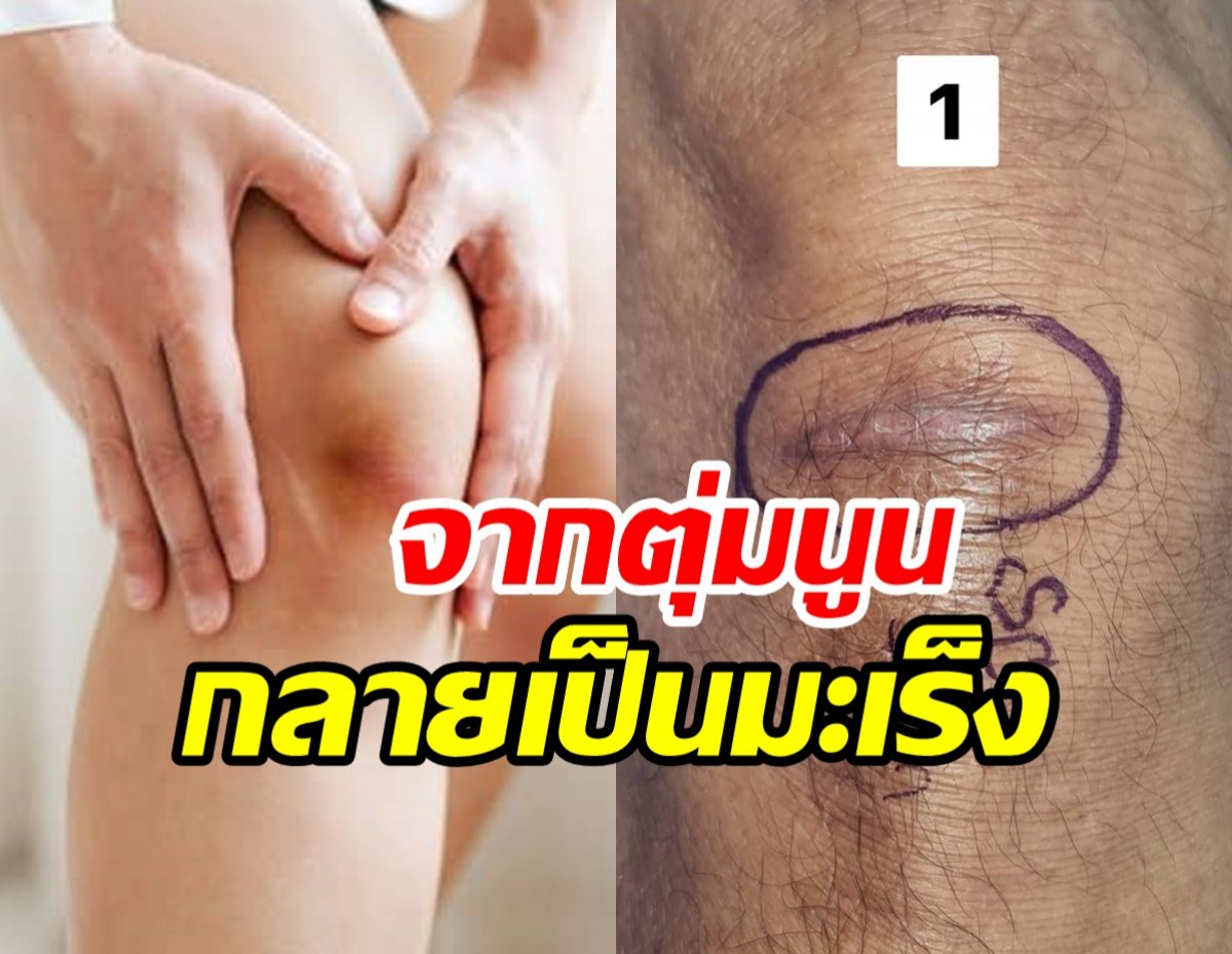  อย่าชะล่าใจ! ตุ่มนูนที่เข่าเจ็บเป็นเดือนไม่หาย สุดท้ายกลายเป็นมะเร็ง 