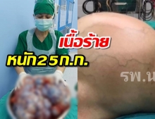 ช็อค! หมอไทยเปิดประสบการณ์ ผ่าตัดมะเร็งรังไข่ขนาดยักษ์