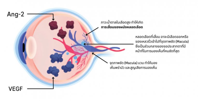 ตาพร่ามัว…อย่าชะล่าใจ ระวังเบาหวานขึ้นจอตา