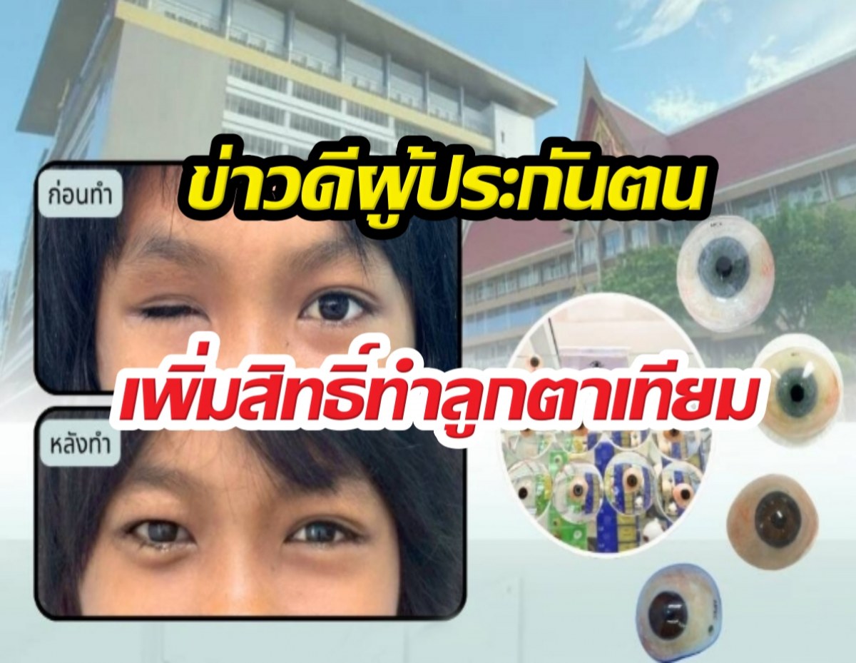 ประกันสังคมเคาะเพิ่มสิทธิ์ทำลูกตาเทียมฟรี เช็กเงื่อนไขด่วน!