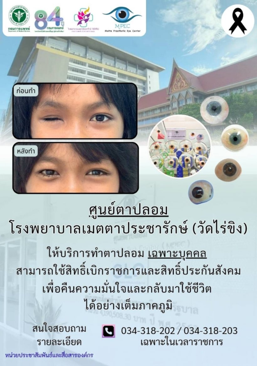ประกันสังคมเคาะเพิ่มสิทธิ์ทำลูกตาเทียมฟรี เช็กเงื่อนไขด่วน!