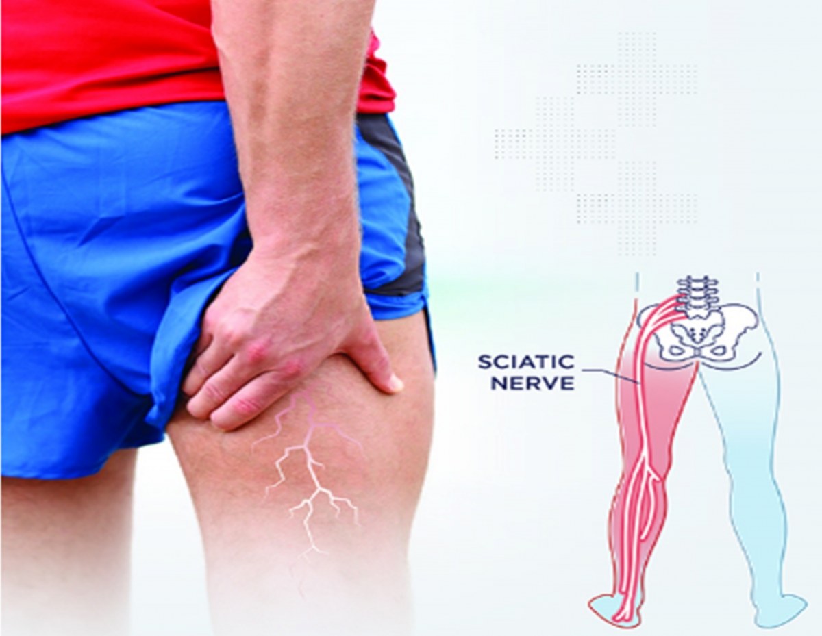 Sciatica pain อาการปวดร้าวลงขา