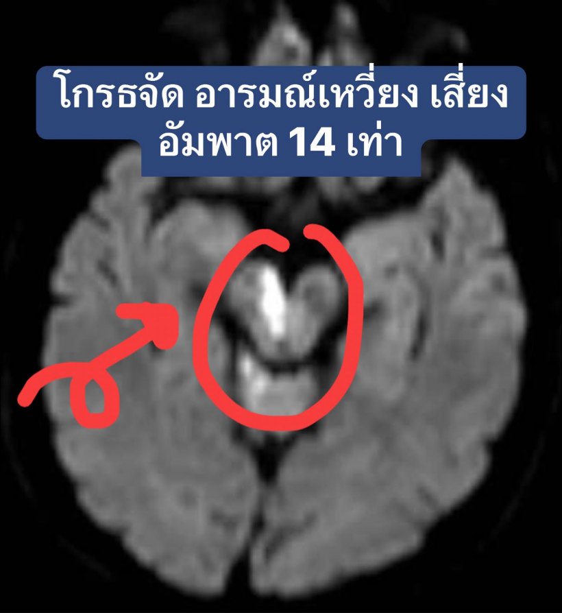 โกรธแค่ไหนก็ต้องคุม! หมอเตือน 4 นิสัย เสี่ยงอัมพาตก้านสมอง