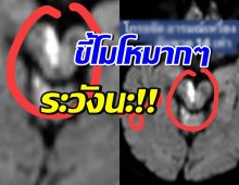 โกรธแค่ไหนก็ต้องคุม! หมอเตือน 4 นิสัย เสี่ยงอัมพาตก้านสมอง