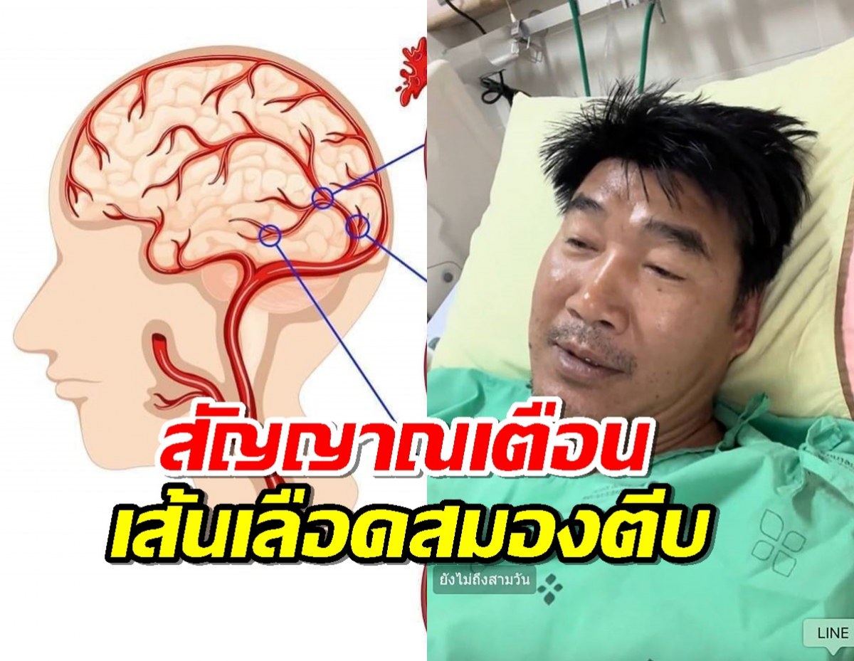 สัญญาณเตือน "เส้นเลือดสมองตีบ" ปัจจัยใดบ้างทำให้เกิดโรค