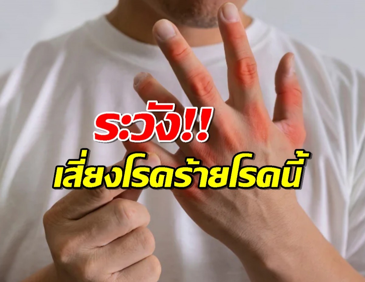 กรดยูริกพุ่ง! หยุดก่อนเก๊าท์จะถามหา!