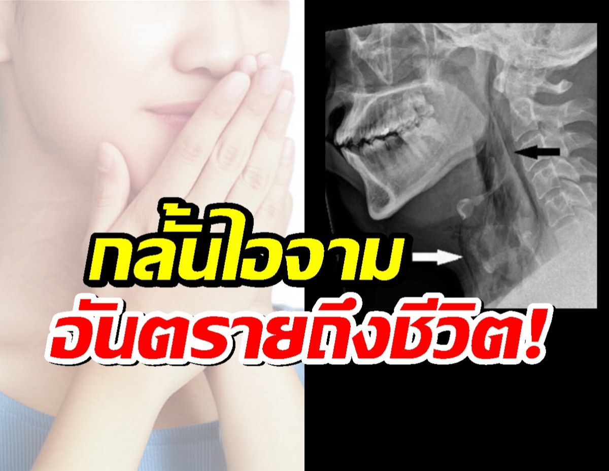 กลั้นไอจาม เสี่ยงอันตรายถึงชีวิต! ภัยเงียบที่หลายคนมองข้าม