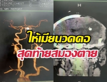 ชายวัย 54 ให้เมียนวดคอ ตื่นมาแขนขาอ่อนแรง สุดท้ายสมองตาย