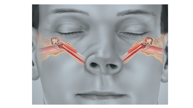 ปวดหัว ปวดหู หูอื้อ กับความผิดปกติของท่อปรับแรงดันหู