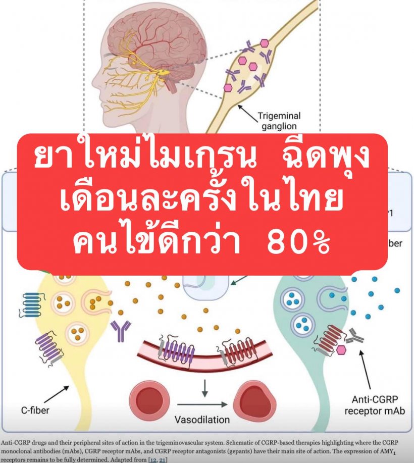 เข้าไทยแล้ว ยาไมเกรนชนิดใหม่ ไม่ต้องเข้าสมอง แต่จับที่ปมประสาท