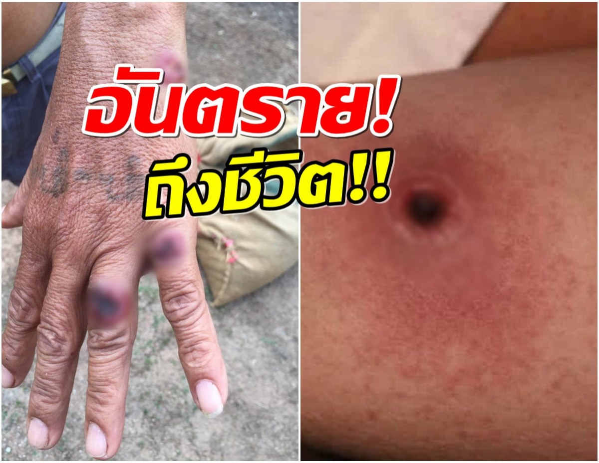 เช็คอาการ แอนแทรกซ์ โรคติดต่อจากสัตว์ ที่ไทยพบผู้เสียชีวิตเเล้ว