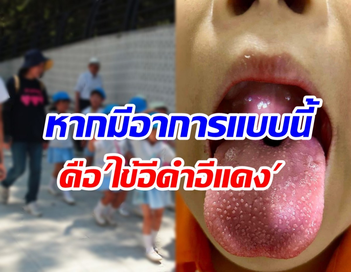 รู้จักโรค ไข้อีดำอีแดง ที่กำลังระบาดในเด็กถึงขั้นต้องหยุดเรียน!