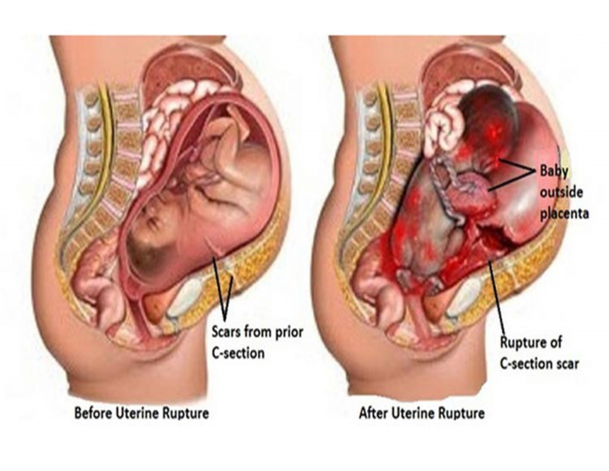 ทำความรู้จัก ภาวะมดลูกเเตก อันตรายทั้งเเม่เเละลูก