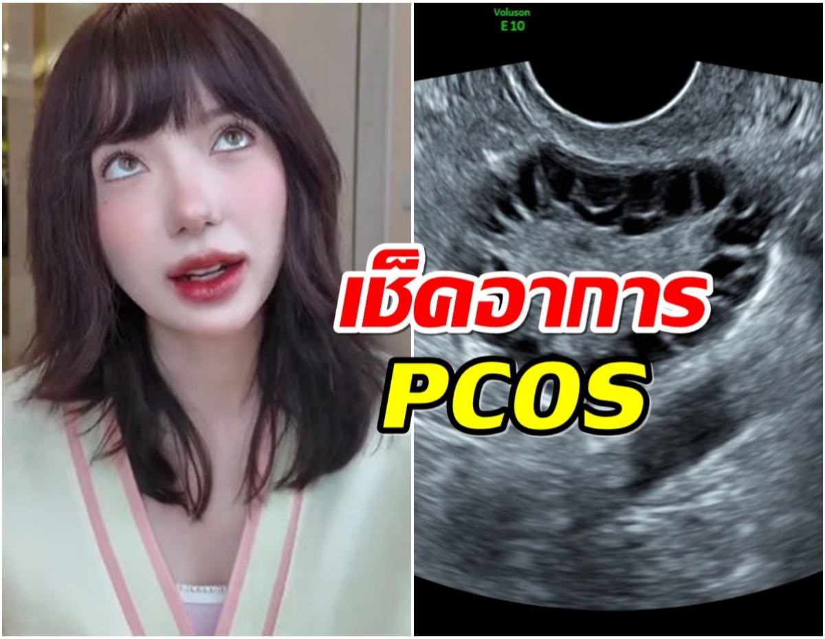 PCOS คืออะไร โรคนี้เกิดกับสาวๆ พลอยชมพู กำลังเผชิญ!